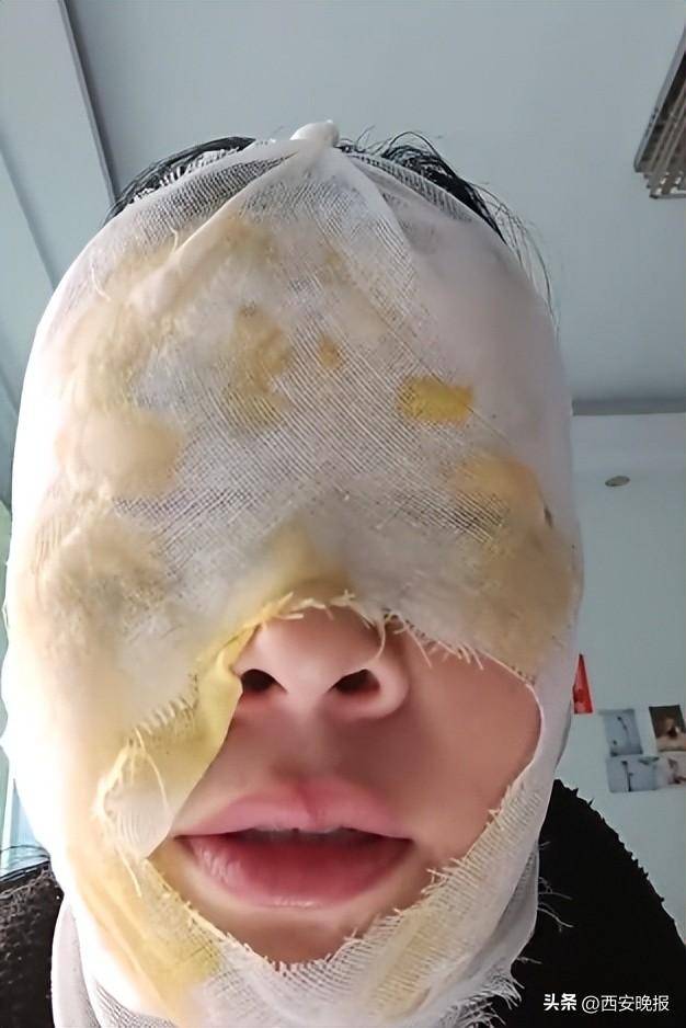 瞬间爆炸，女子脸部被严重烫伤！网友：我也差点信了
