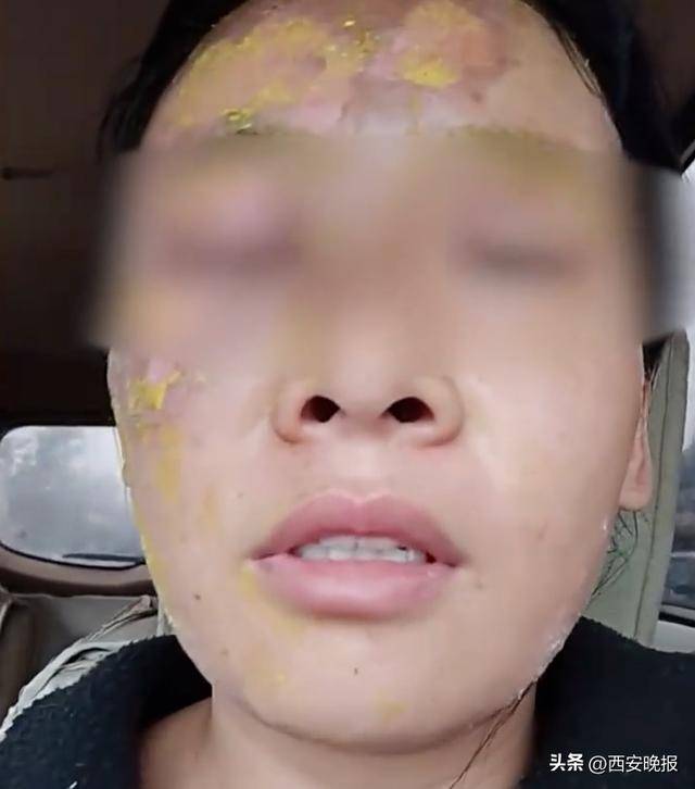 瞬间爆炸，女子脸部被严重烫伤！网友：我也差点信了